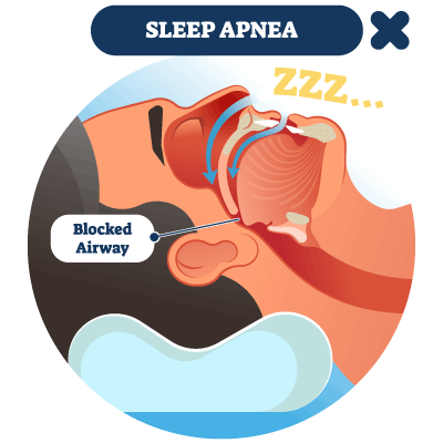 obstructed breathing during sleep