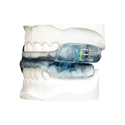 dental appliance for the treatment of sleep apnea